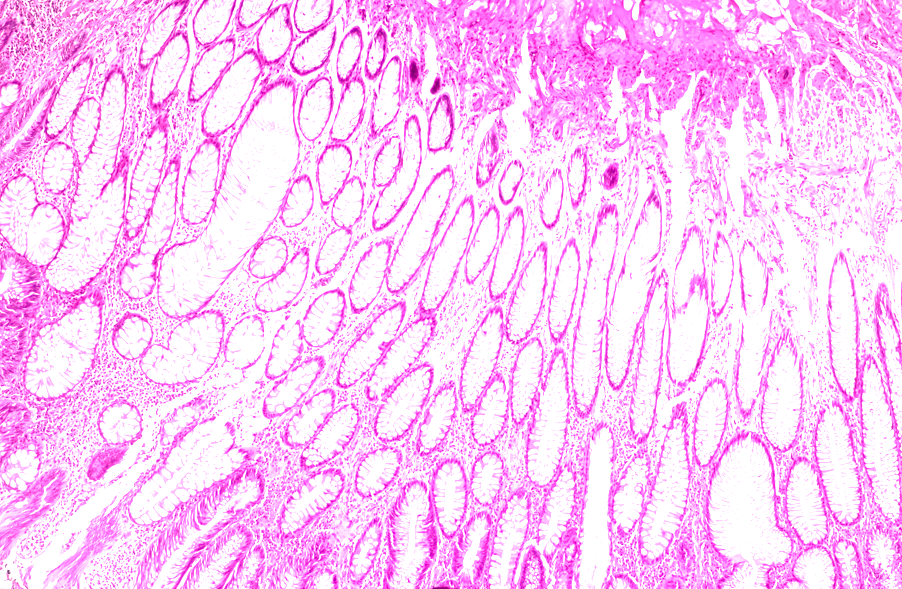colorectal cancer